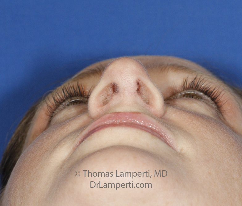 Rhinoplasty After Base