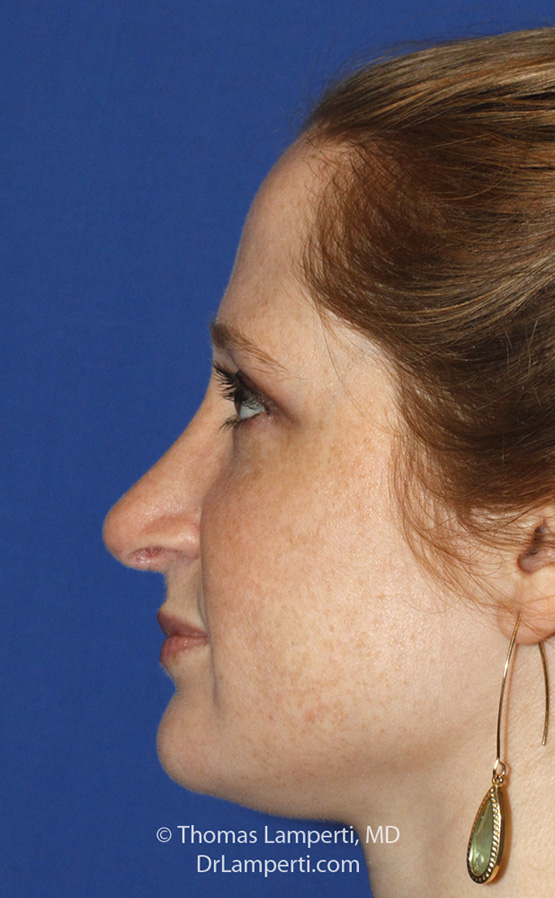 Rhinoplasty After L Profile