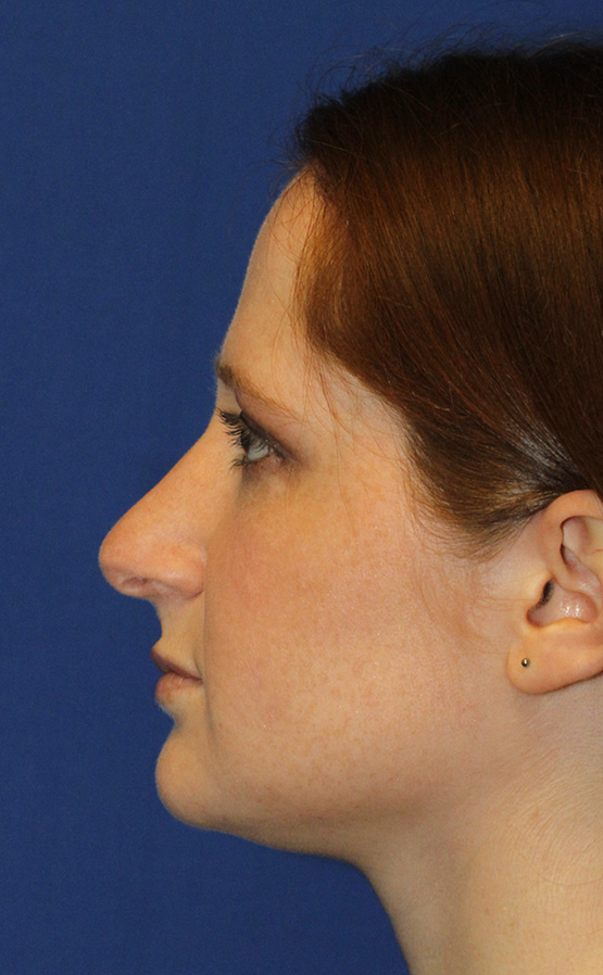 Rhinoplasty Before L Profile