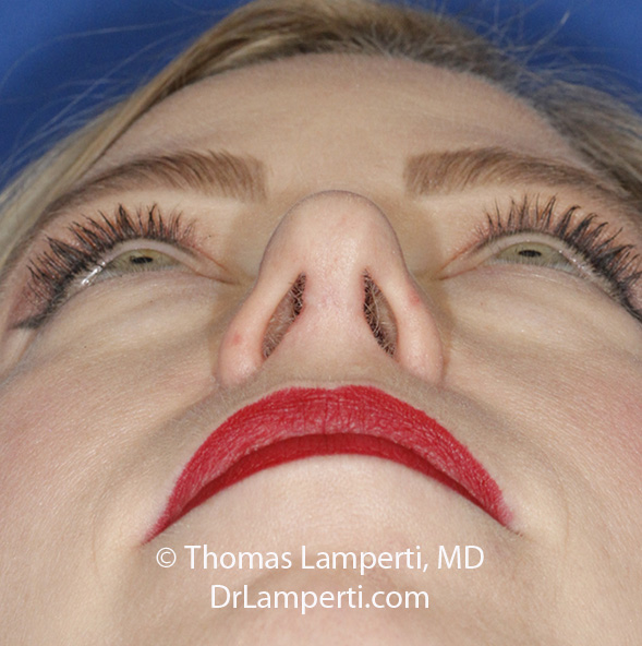 Rhinoplasty After Base