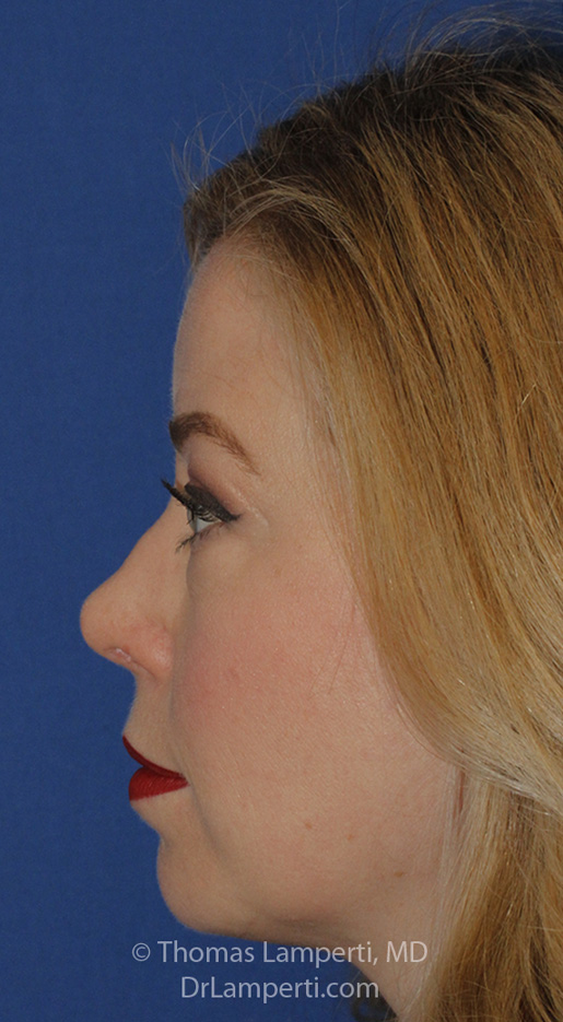 Rhinoplasty After L Profile