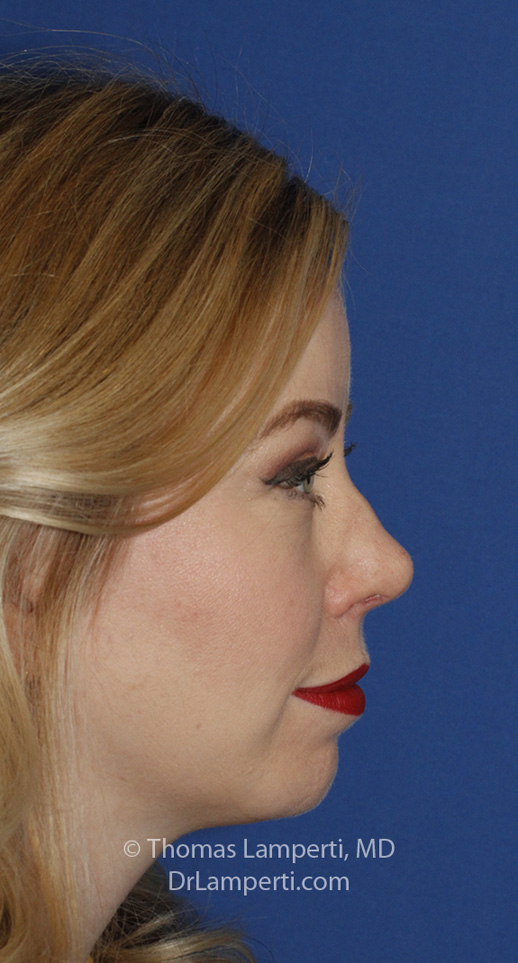 Rhinoplasty After R Profile