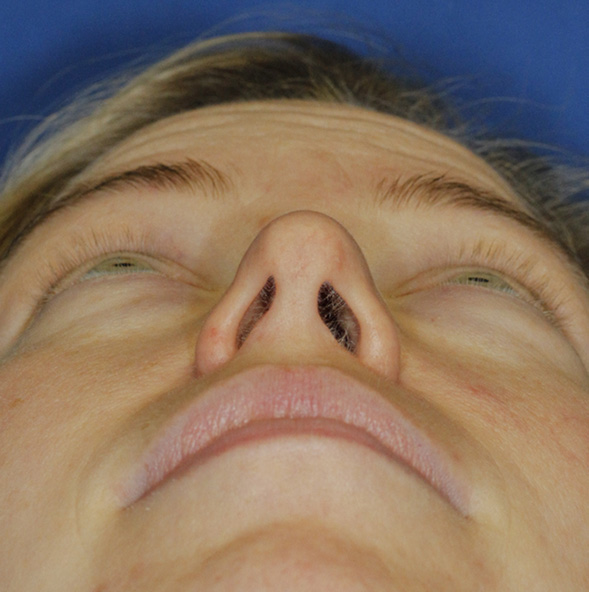 Rhinoplasty Before Base