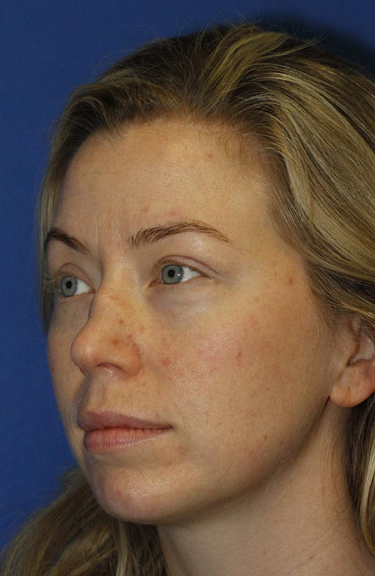 Rhinoplasty Before L Oblique