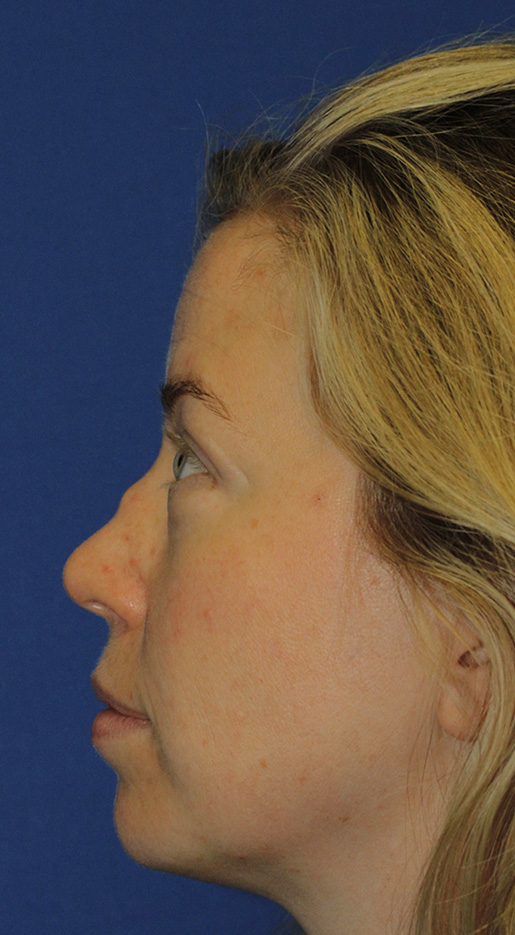 Rhinoplasty Before L Profile