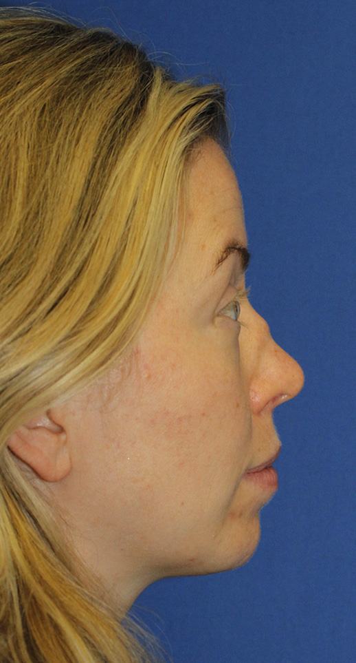 Rhinoplasty Before R Profile