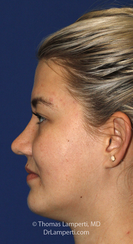 Rhinoplasty After L Profile