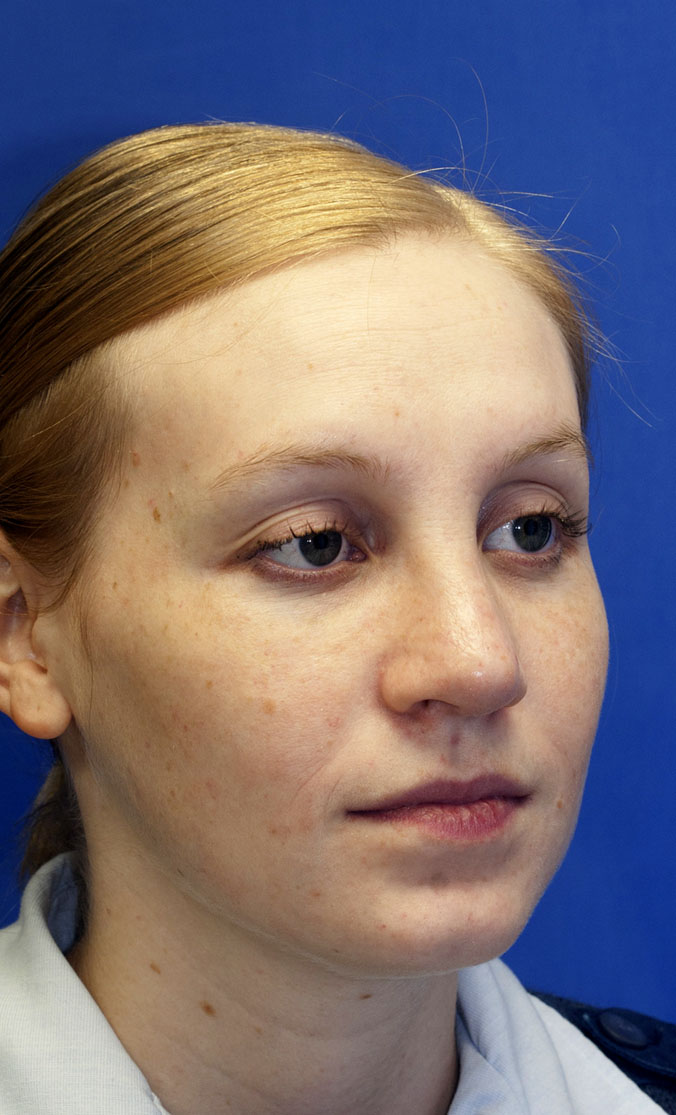 After Rhinoplasty photo