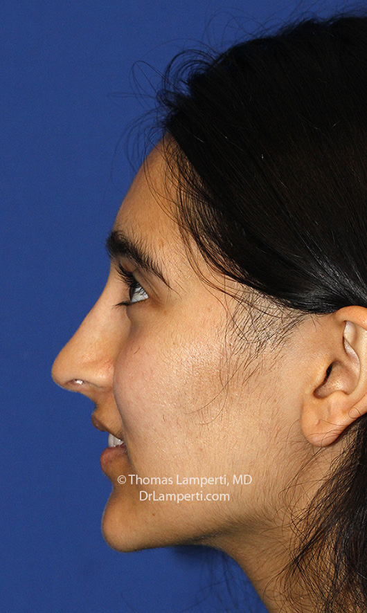 Rhinoplasty After L Profile