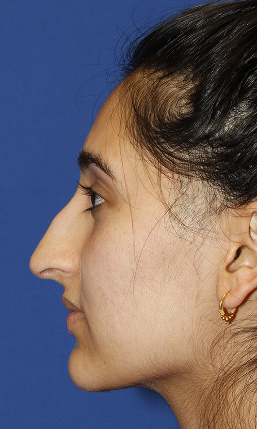 Rhinoplasty Before L Profile