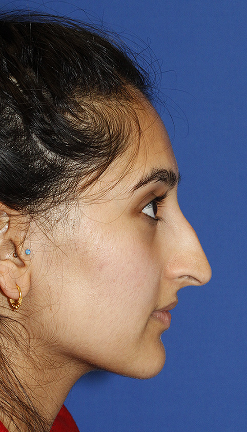 Rhinoplasty Before R Profile