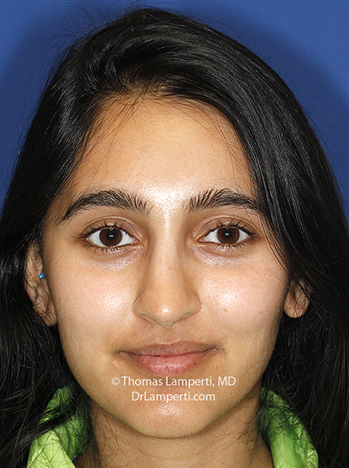 Rhinoplasty After Frontal