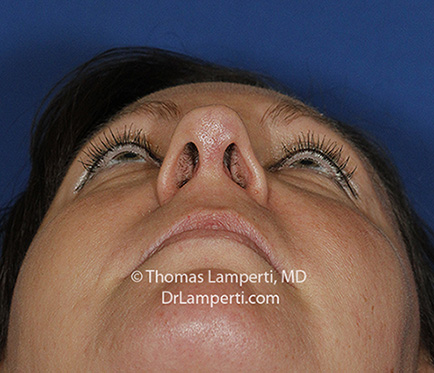 Rhinoplasty After Base