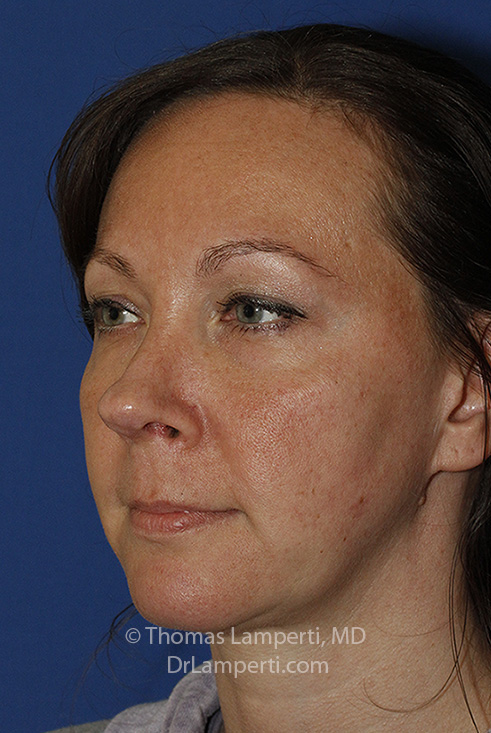 Rhinoplasty After L Oblique