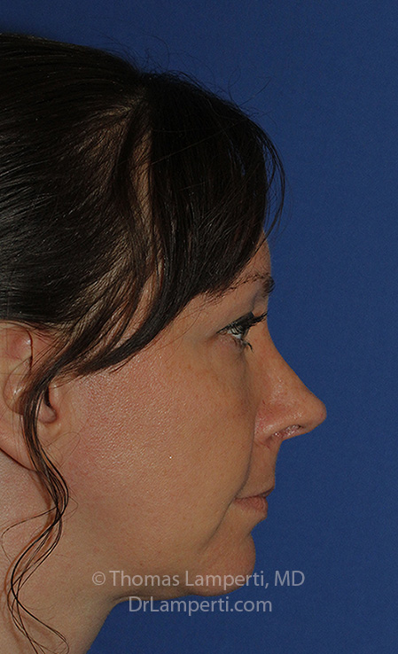 Rhinoplasty After R Profile