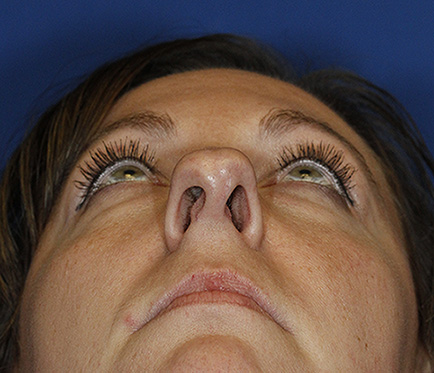 Rhinoplasty Before Base