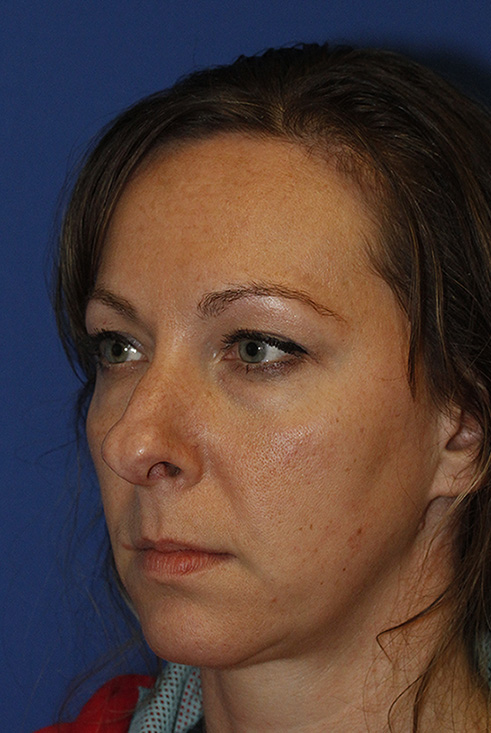 Rhinoplasty Before L Oblique