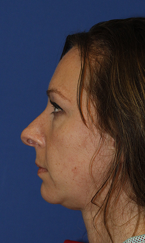 Rhinoplasty Before L Profile