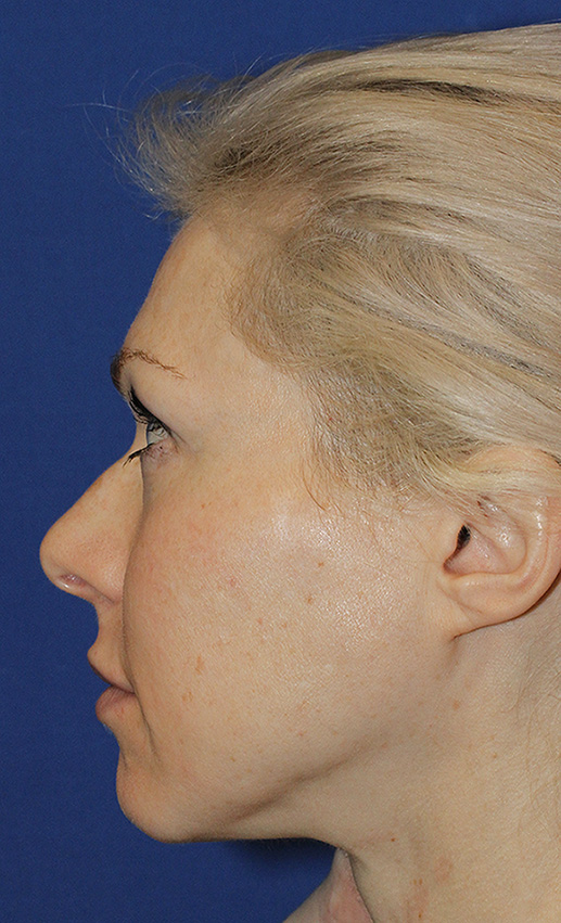Rhinoplasty Before L Profile