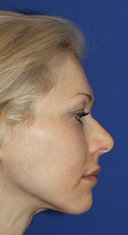 Rhinoplasty Before R Profile