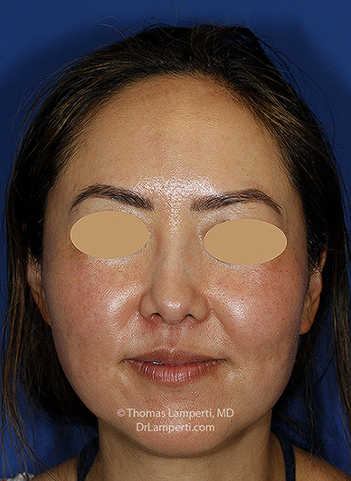 Rhinoplasty After Frontal