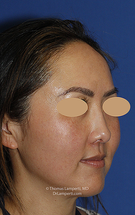 Rhinoplasty After R Oblique