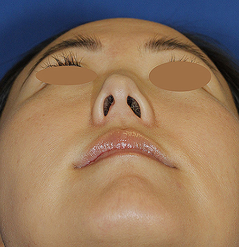 Rhinoplasty Before Base