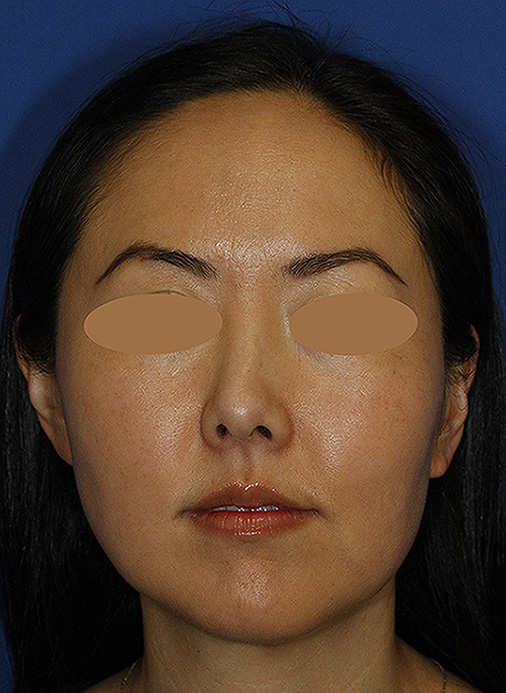 Rhinoplasty Before Frontal