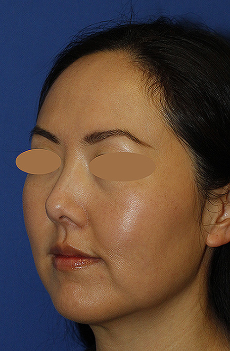 Rhinoplasty Before L Oblique