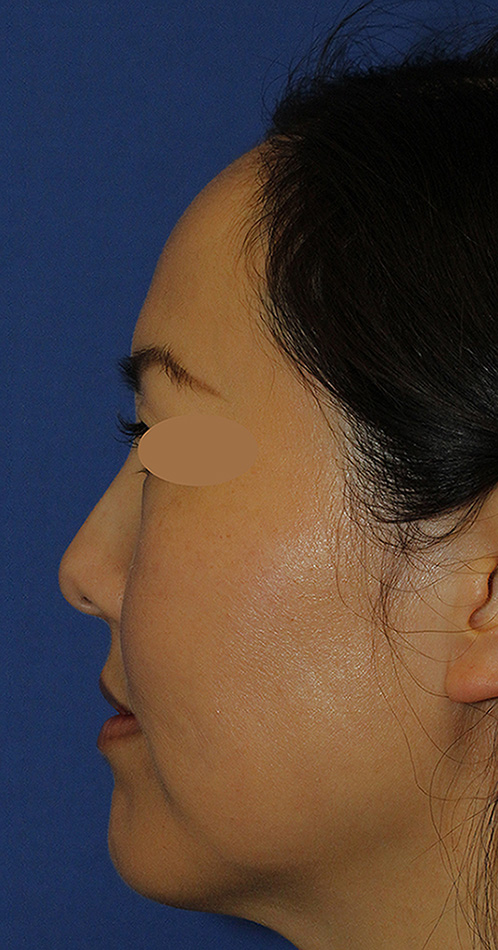 Rhinoplasty Before L Profile