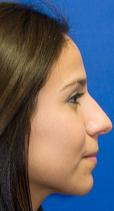 Before Rhinoplasty Photo