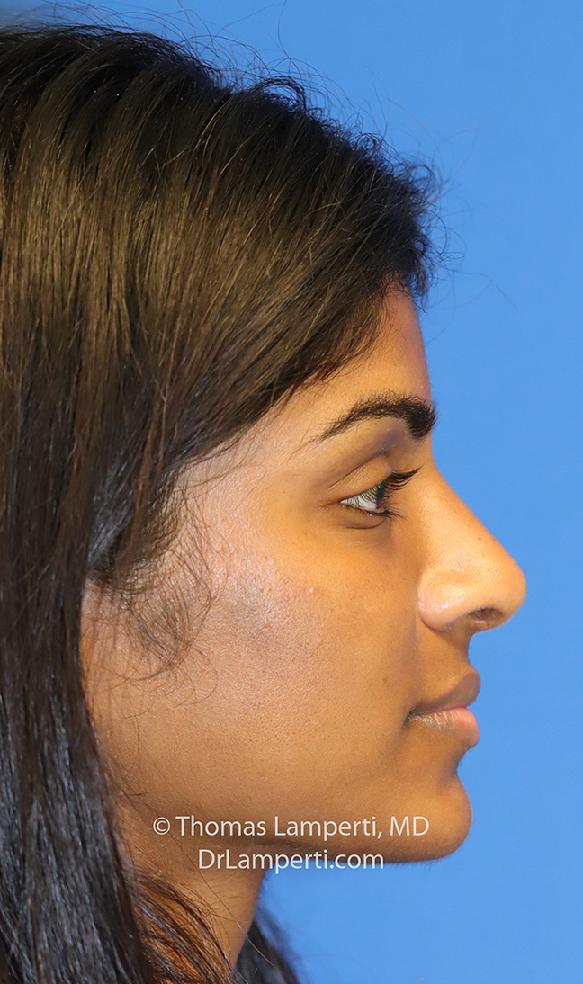 R profile after