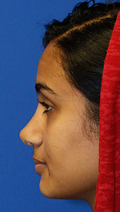 Postop rhinoplasty profile