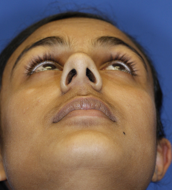 Preop rhinoplasty base