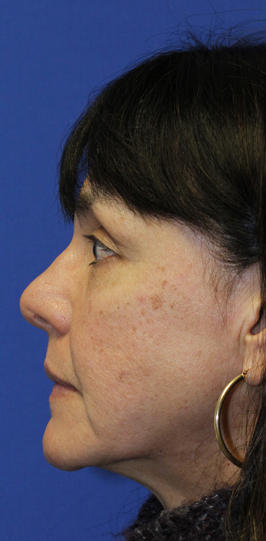 Rhinoplasty Before profile photo