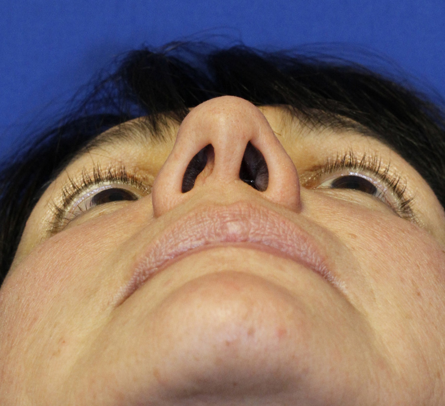 Rhinoplasty Before base photo