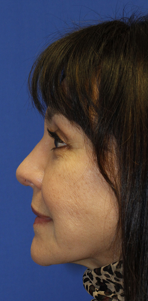 Rhinoplasty After profile photo