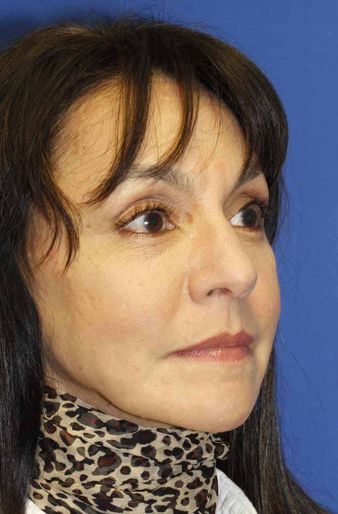 Rhinoplasty After oblique photo