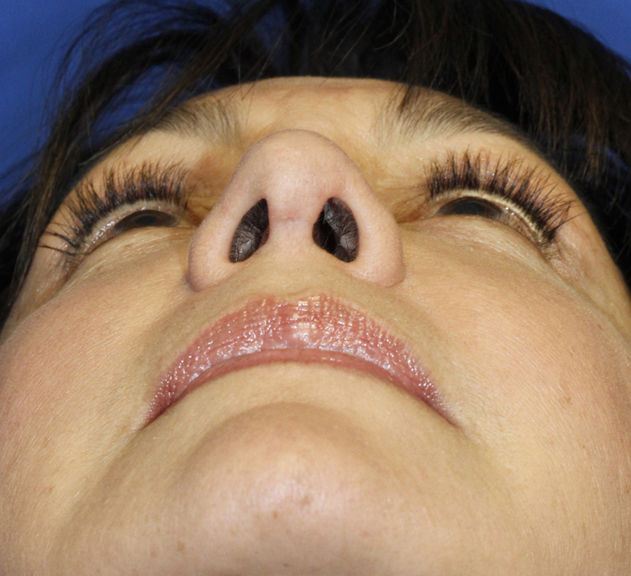 Rhinoplasty After base photo