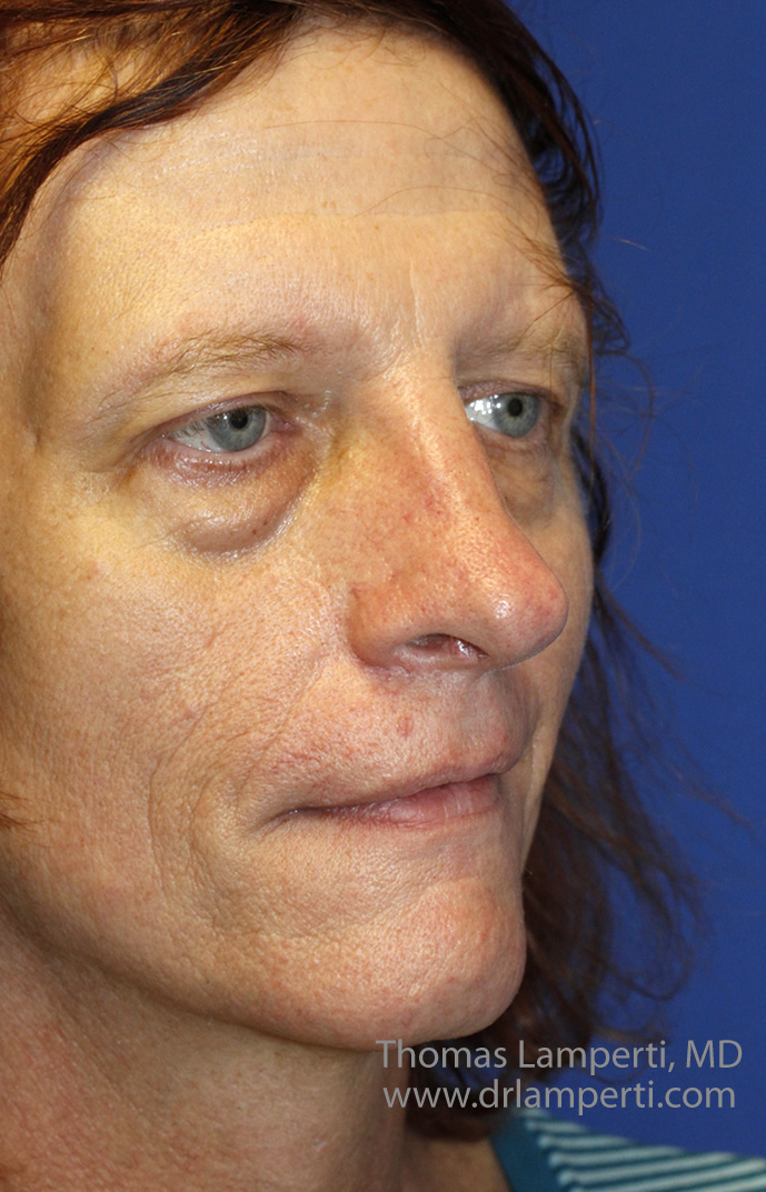 After Oblique Nasal Feminization