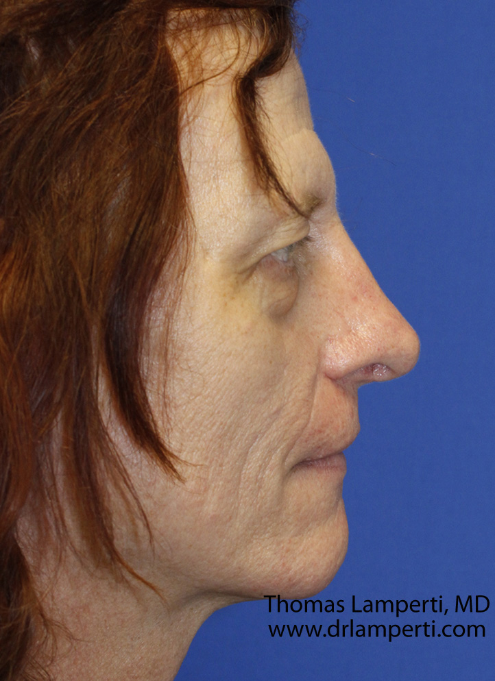 After Profile Nasal Feminization