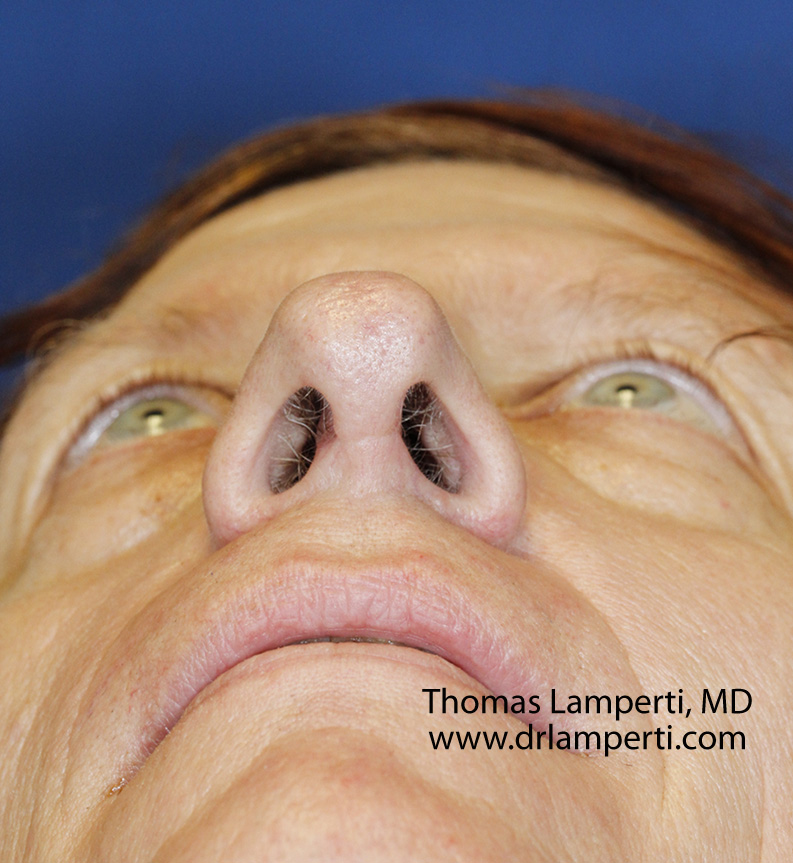 After Base Nasal Feminization