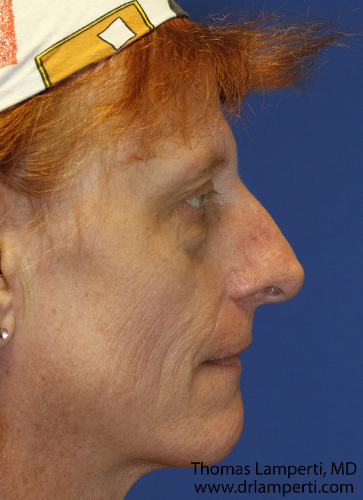 Before Profile Nasal Feminization