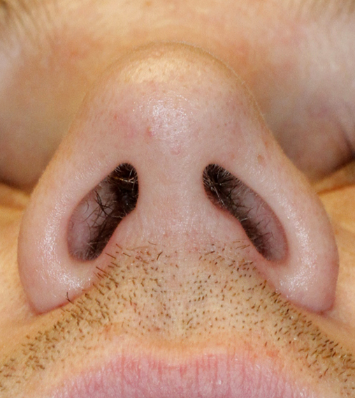 After Nostril Reduction Rhinoplasty