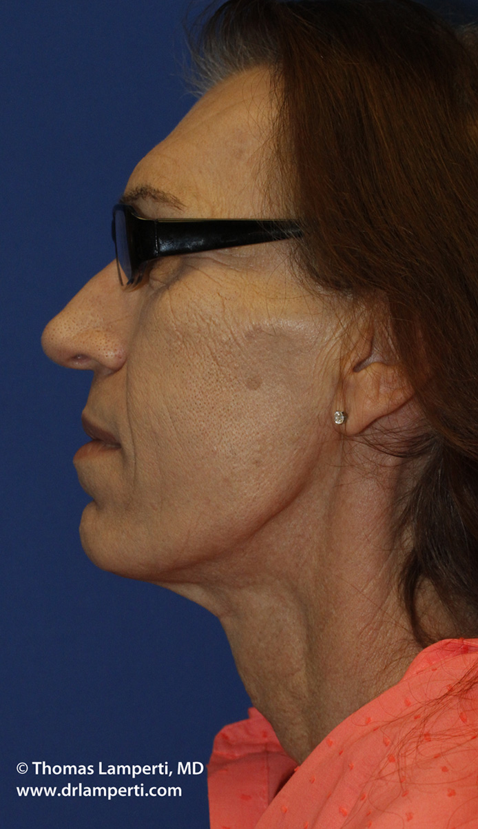 After Tracheal Shave L Profile