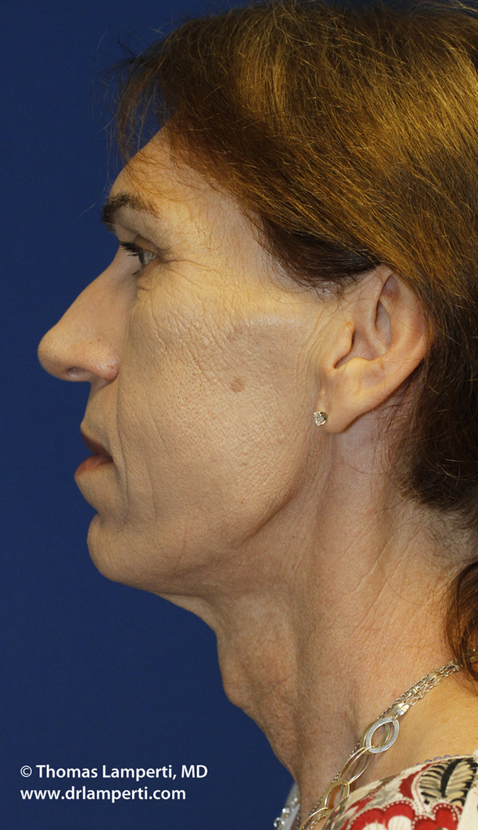 Before Tracheal Shave L Profile