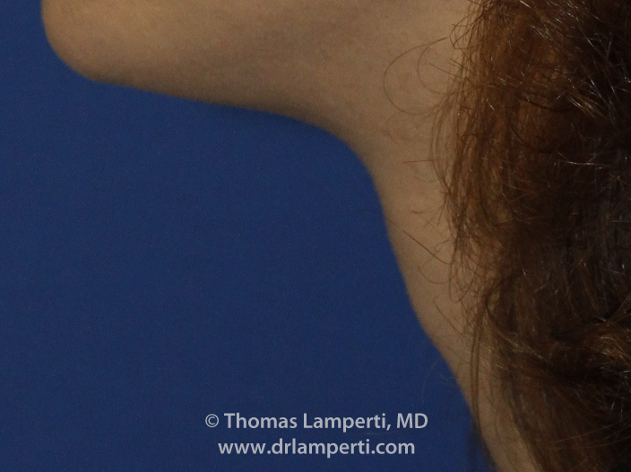 Tracheal Shave L Profile After