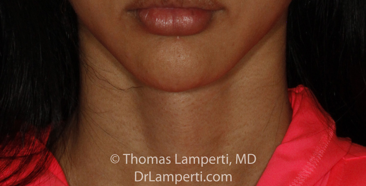 Tracheal Shave After Frontal