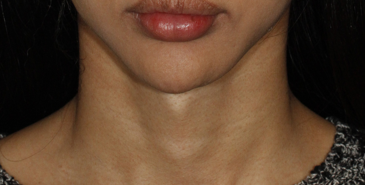Tracheal Shave Before Frontal