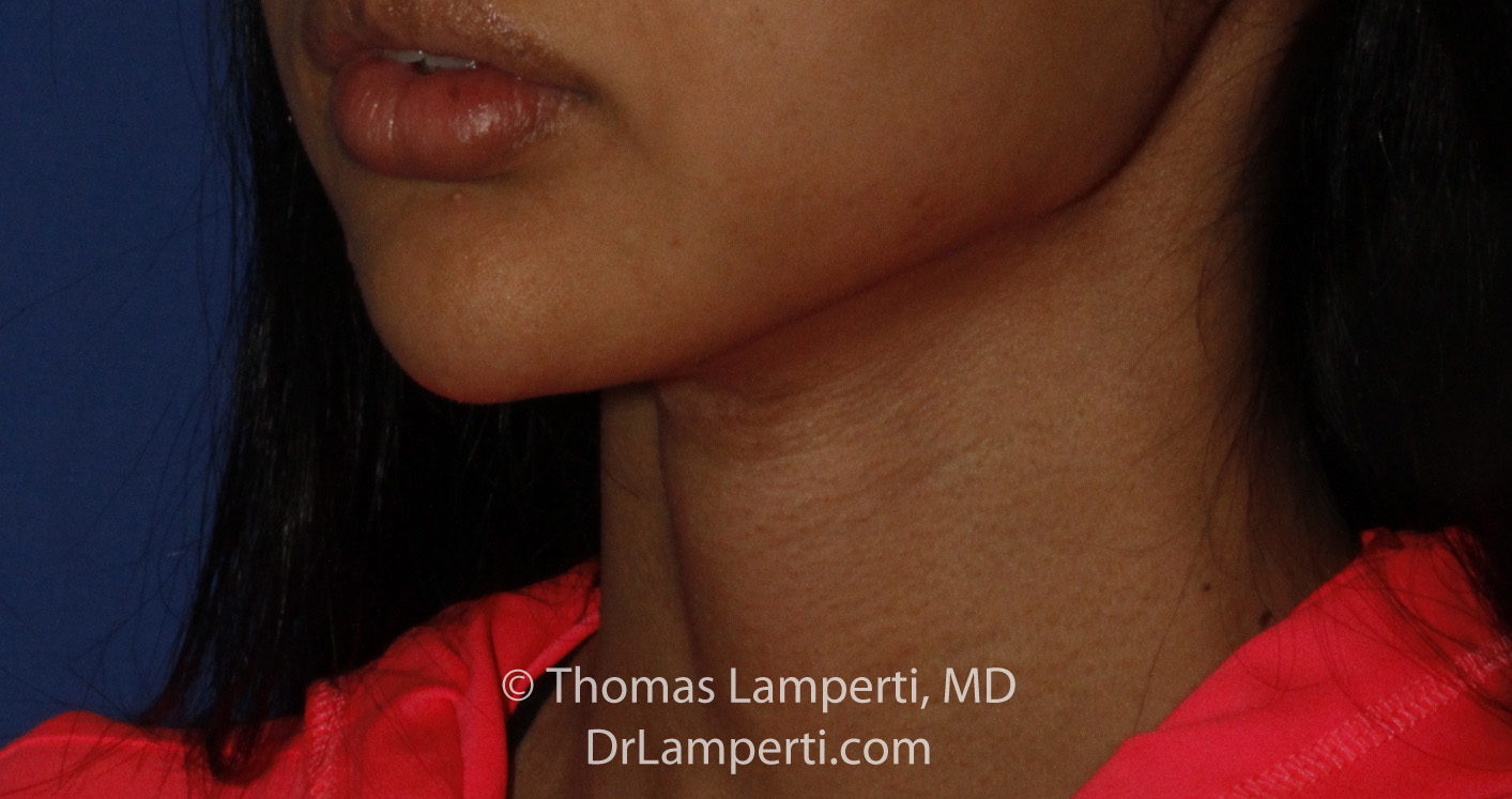 Tracheal Shave After L Oblique